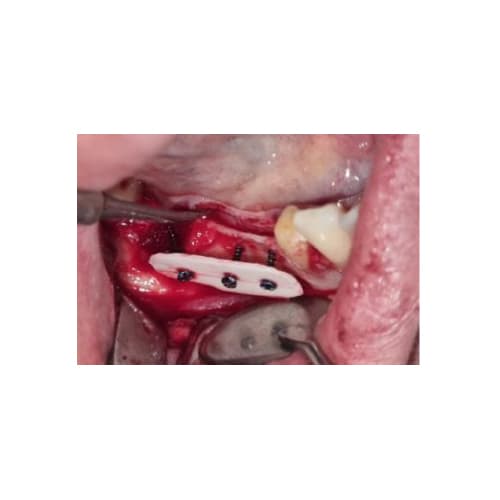 Cortical Plate – syntetyczna, resorbowalna płytka kortykalna – 25x10x1 mm ( 2szt.)