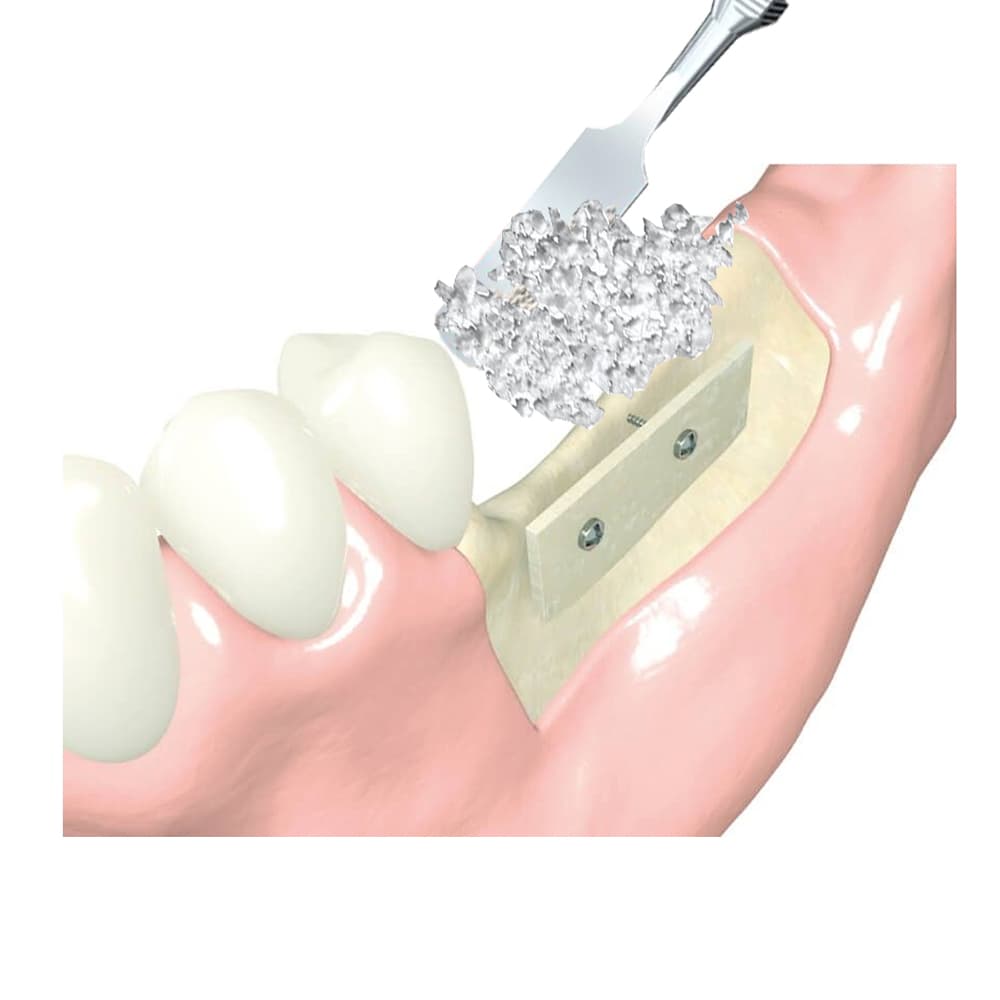 Cortical Plate – syntetyczna, resorbowalna płytka kortykalna – 25x10x1 mm ( 2szt.)